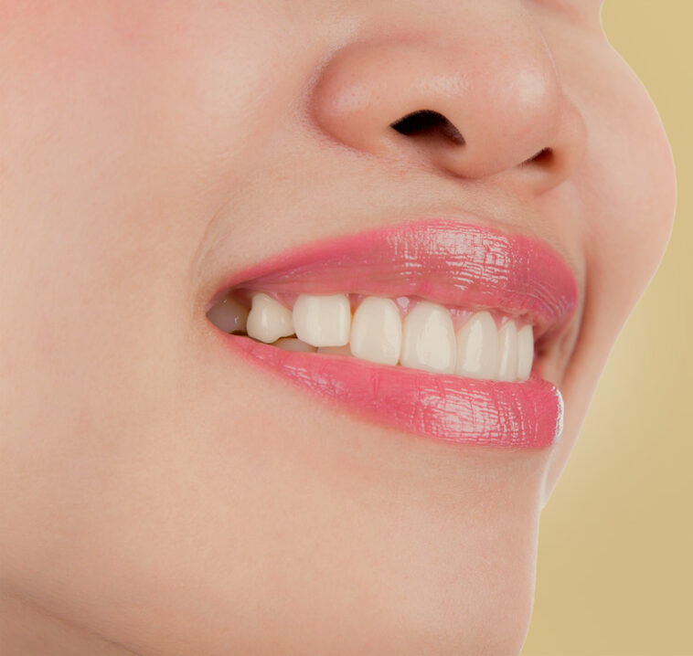 Antes y después sonrisa gingival en Málaga con Botox - Caso real Nueuromoduladores Málaga Rejuvelook- Sonrisa perfecta.