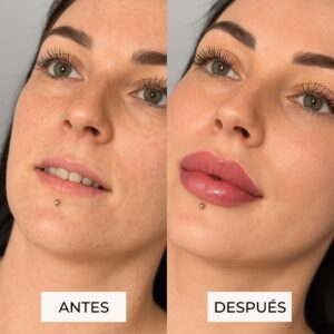 antes y después aumento de labios en Málaga - Rejuvelook Clinica estetica en Malaga