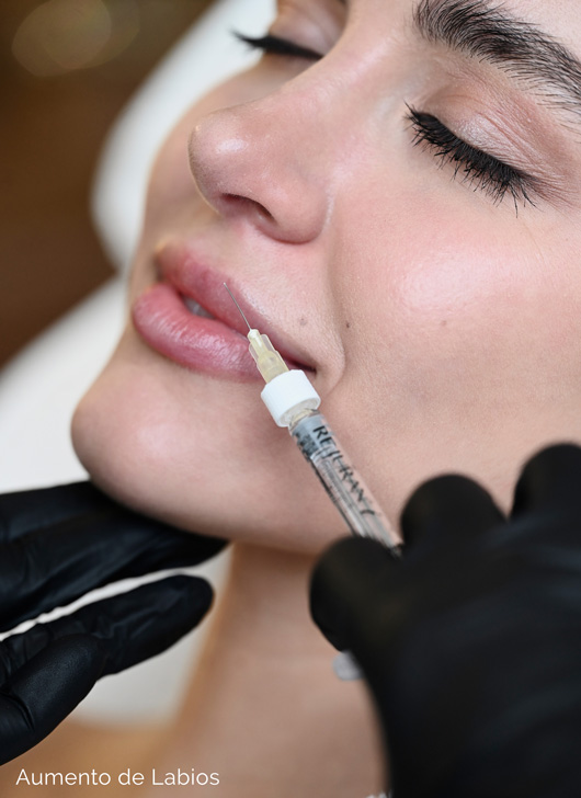 infografia del proceso de inyeccion de acido hialuronico en labios en Fuengirola